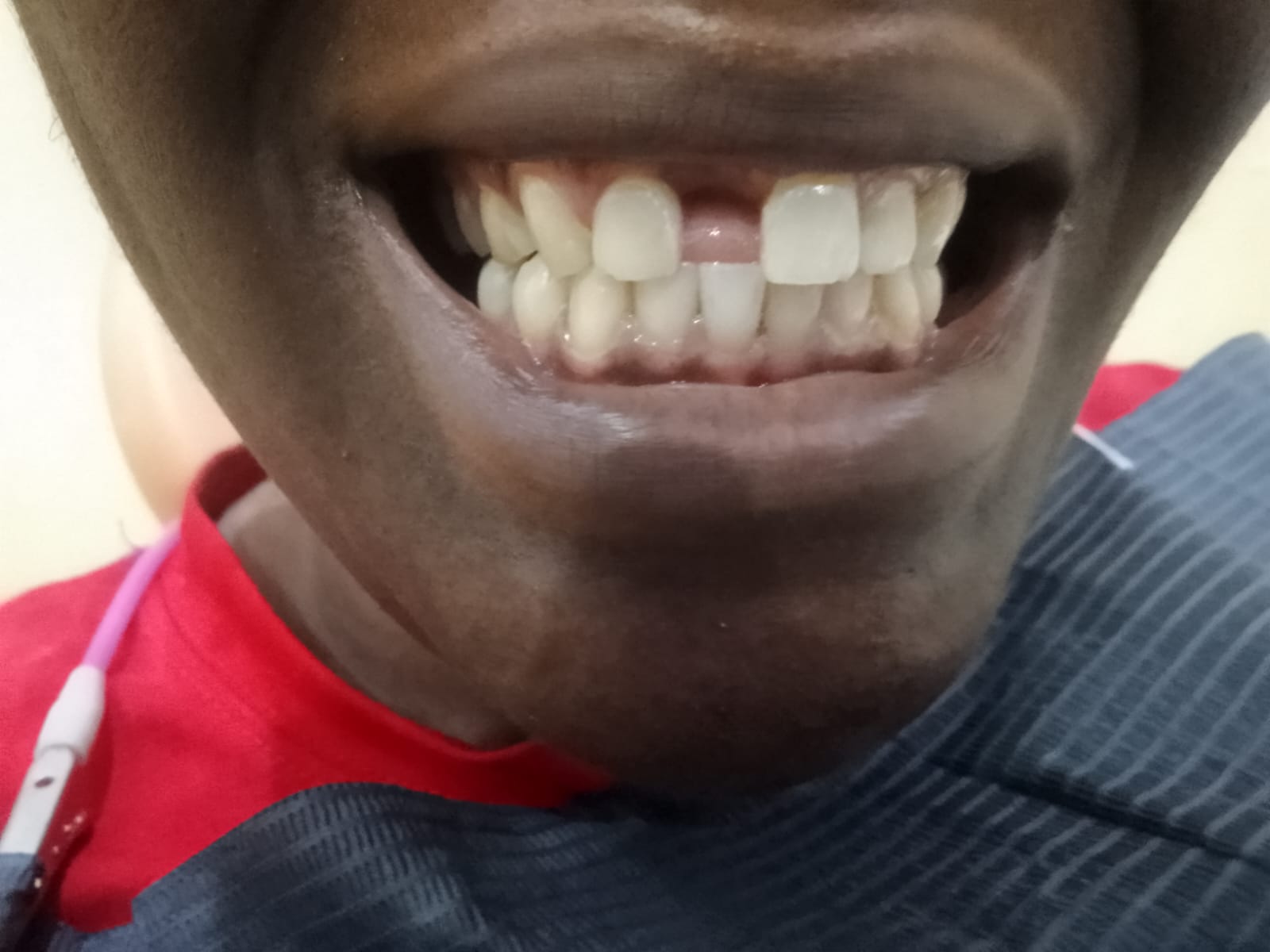 Antes do tratamento dentário