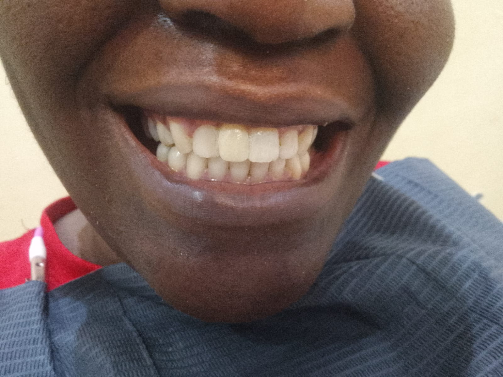 Depois do tratamento dentário