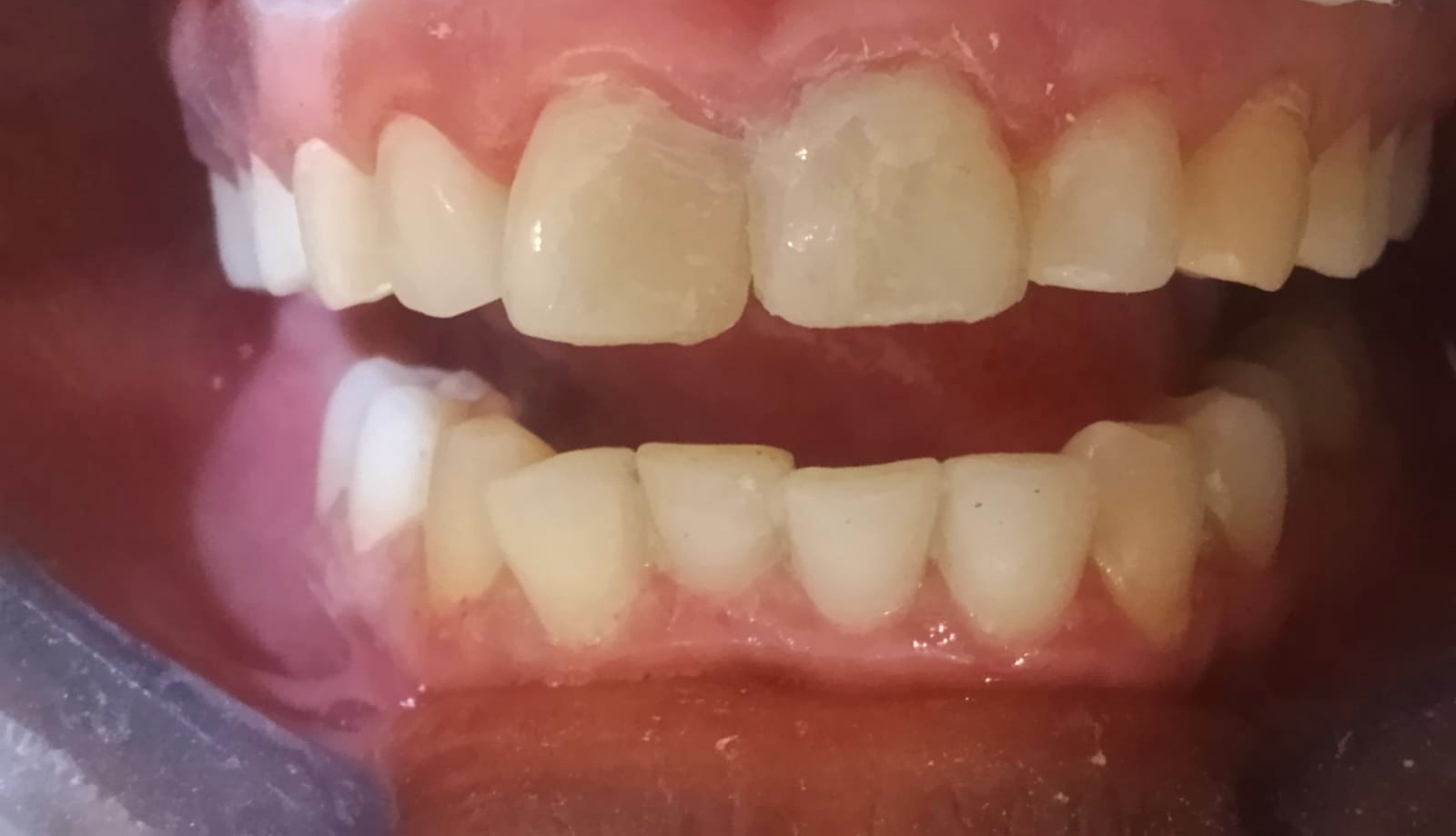Depois da restauração estética